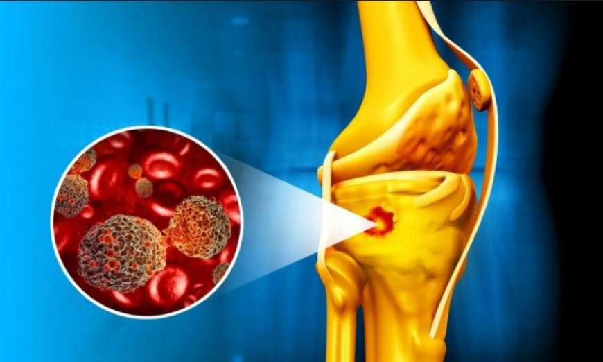 جسيمات نانوية مغناطيسية تكافح سرطان العظام وتعزز الشفاء بشكل فعال