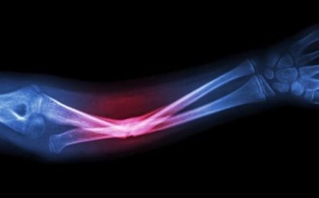 ابتكار جديد يستخدم مخلفات الأسماك لتعزيز نمو العظام بفعالية