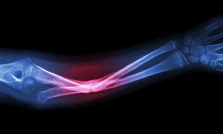 ابتكار جديد يستخدم مخلفات الأسماك لتعزيز نمو العظام بفعالية