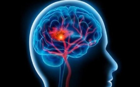 اكتشاف تقنيات جديدة لإزالة جلطات الدماغ بفضل الذكاء الاصطناعي