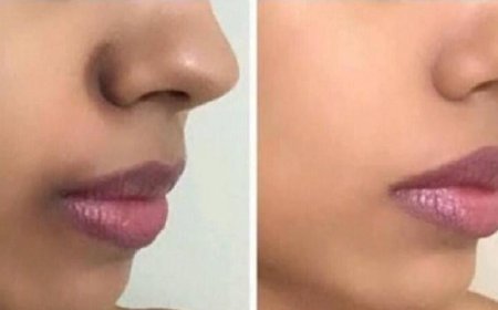 التصبغات حول الفم أسبابها وطرق فعالة لعلاجها طبيعياً وطبيبياً