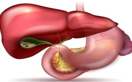 نساء أكثر عرضة للإصابة بحصوات المرارة تعرف على الأسباب والعوامل المؤثرة