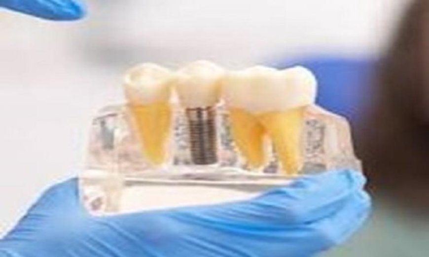 ابتكار مادة حيوية ثورية تعيد تعريف علاج وترميم الأسنان