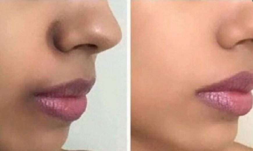 التصبغات حول الفم أسبابها وطرق فعالة لعلاجها طبيعياً وطبيبياً