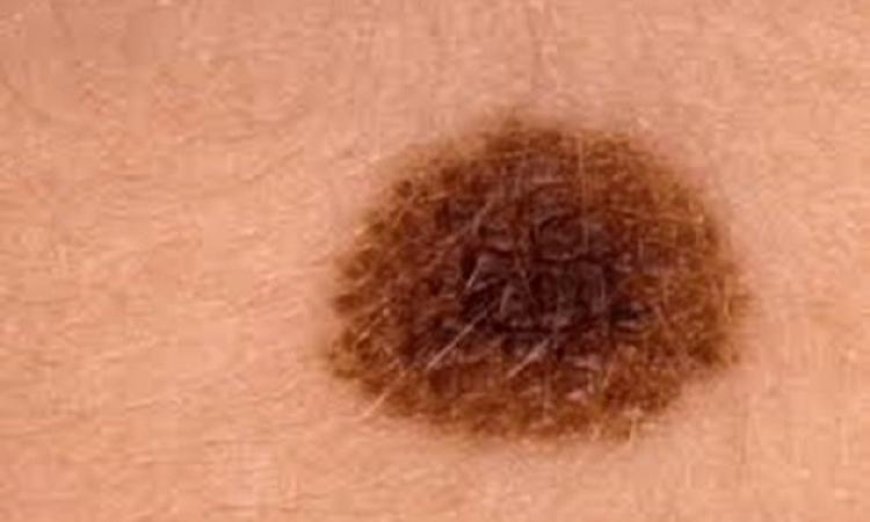 علماء يحدثون ثورة في علاج الميلانوما برقعة حرارية تستهدف الخلايا بدون الحاجة للجراحة