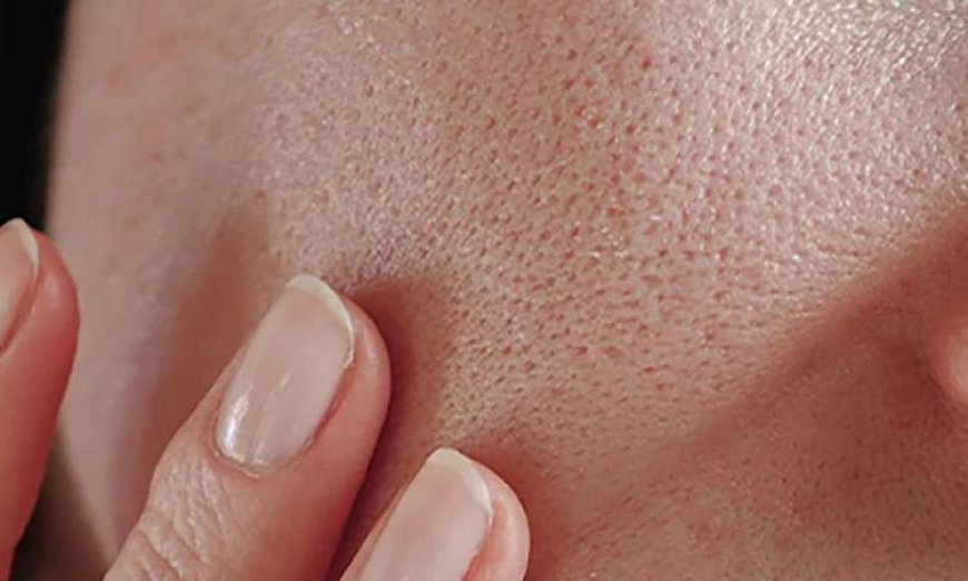 أفضل وصفات طبيعية للتخلص من المسام الواسعة بشكل فعال