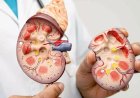 دراسة تكشف عن قدرة غير متوقعة لدواء شائع لعلاج الإمساك في حماية الكلى