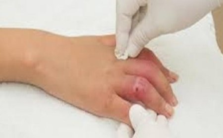 جزيئات دقيقة من الديدان تساهم في علاج الجروح المزمنة وتحسين نوعية الحياة