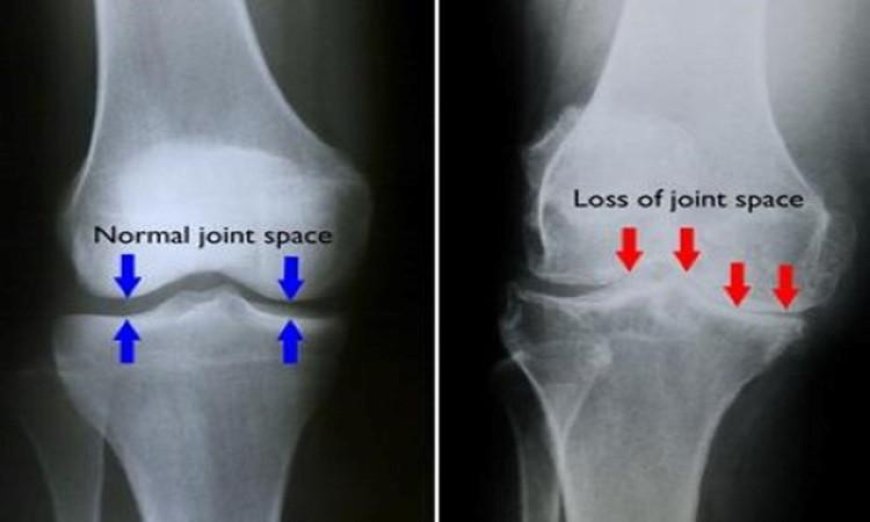 اكتشاف ثوري لعلماء يتيح تخفيف ألم خشونة الركبة بطرق بسيطة دون الحاجة للدواء أو الجراحة