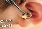 اكتشف الحقائق المثيرة عن شمع الأذن والمخاطر المرتبطة بإزالته