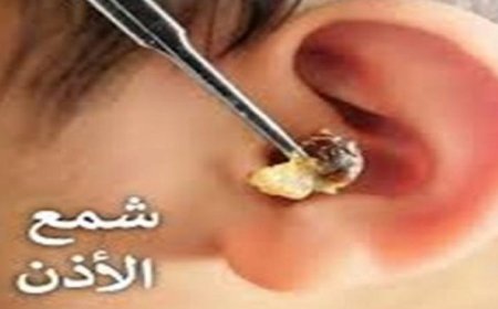 اكتشف الحقائق المثيرة عن شمع الأذن والمخاطر المرتبطة بإزالته