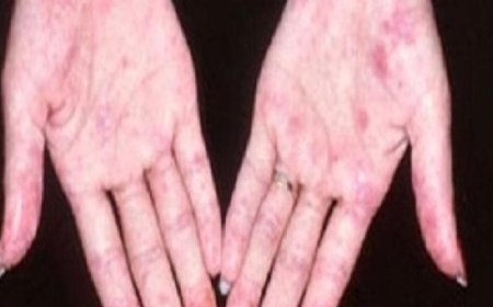 زيادة خطر إصابة النساء بالذئبة الحمراء وأهم أسبابها