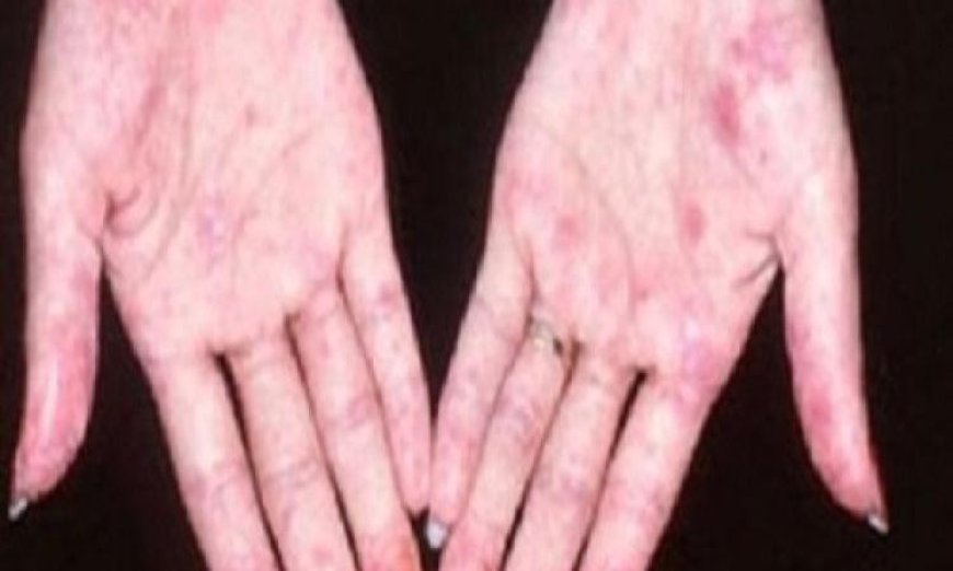 زيادة خطر إصابة النساء بالذئبة الحمراء وأهم أسبابها