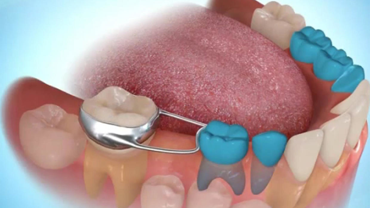 فوائد ضمادات الأسنان بعد توتر العصب