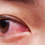 أعراض جفاف العين والصداع