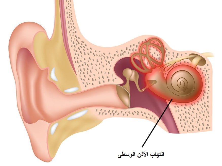 ما هي أعراض التهاب الأذن الوسطى عند الأطفال والبالغين ايوا مصر