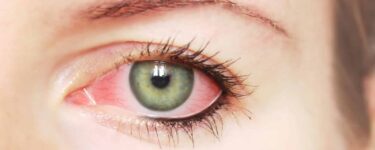 ما هي أسباب ألم العين عند تحريكها؟