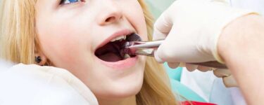 هل خلع الضرس يؤثر على باقي الأسنان