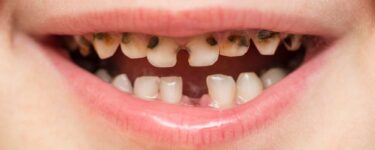 تفسير حلم الأسنان السوداء في المنام