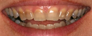 تفسير حلم الأسنان المتسخة في المنام