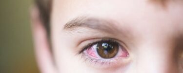 علاج احمرار العين عند الأطفال بالأعشاب