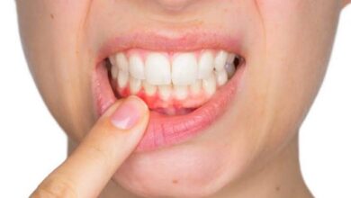 زوائد لحمية في الفم